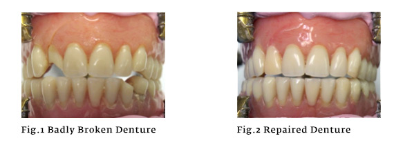 denture-repairs-smilecrafters-staffordshire.jpg